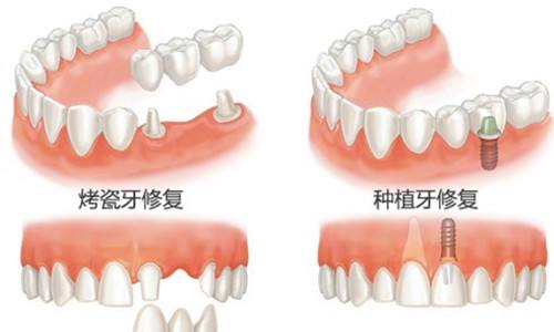 缺牙补牙技术的历史演变与现代发展，早期技术探究